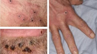Photo of Health Ministry Reports Suspected Mpox Case; Patient Stable and Isolated