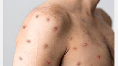 Photo of First Case of Clade 1B M-Pox Variant Detected in Kerala
