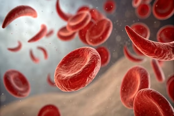 Six crore screened under Sickle Cell Mission; over 2 lakh diagnosed, 16 ...